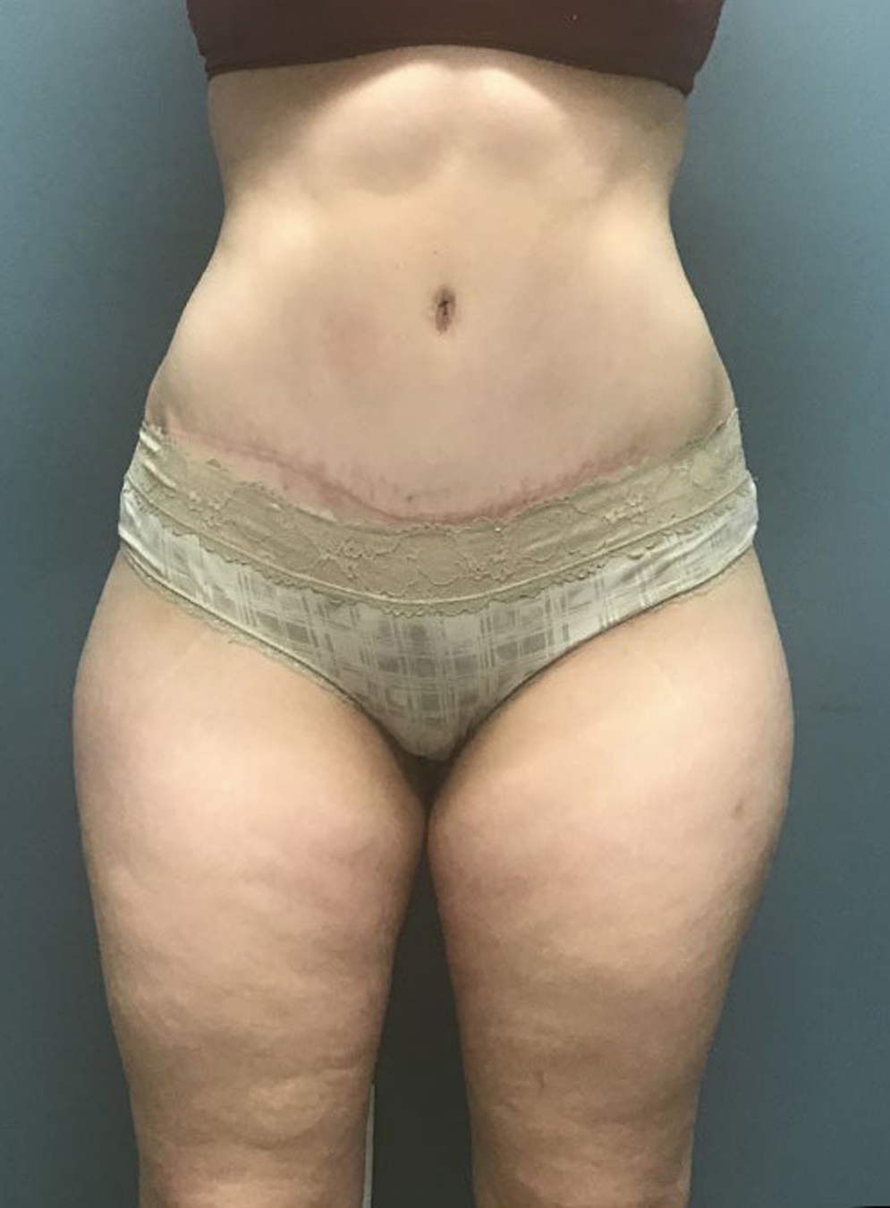 Tummy Tuck Patient Photo - Case 3815 - after view-0