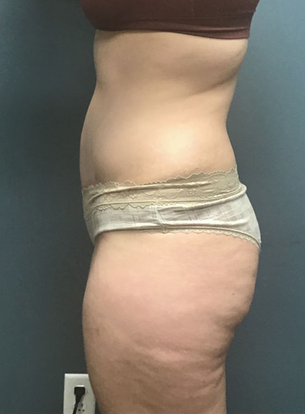 Tummy Tuck Patient Photo - Case 3815 - after view-3