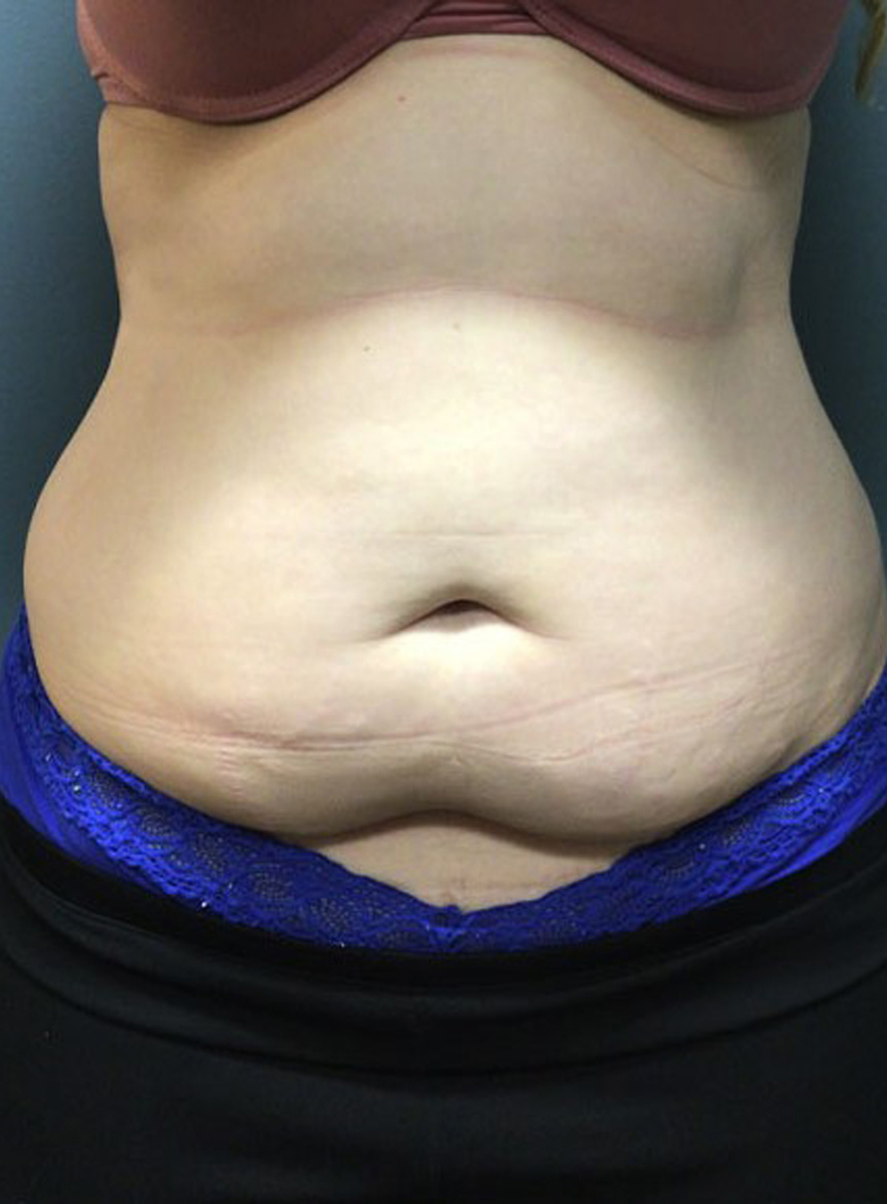 Tummy Tuck Patient Photo - Case 3815 - before view-0
