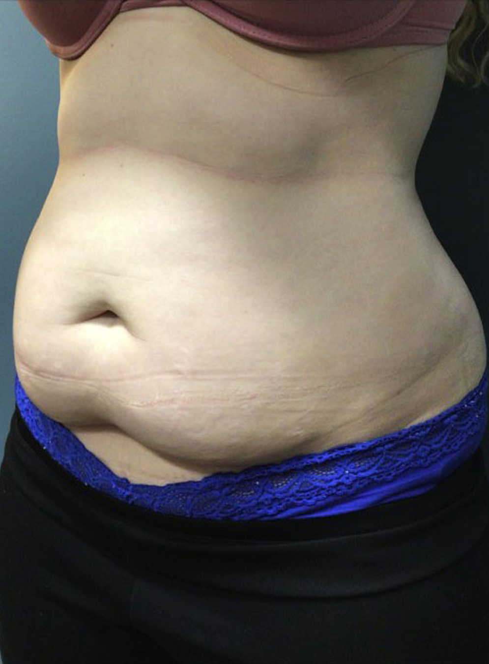 Tummy Tuck Patient Photo - Case 3815 - before view-2