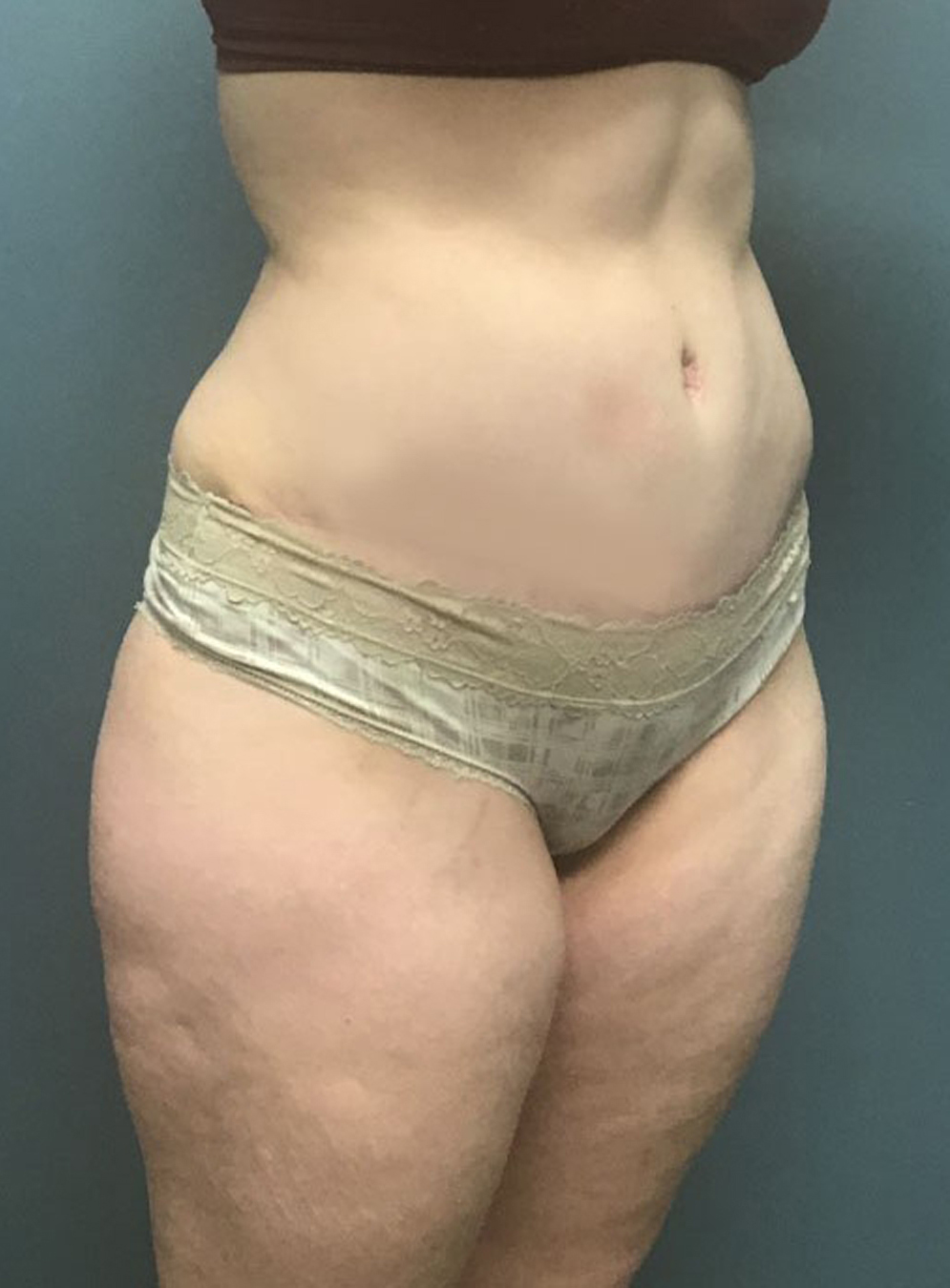 Tummy Tuck Patient Photo - Case 3815 - after view-1