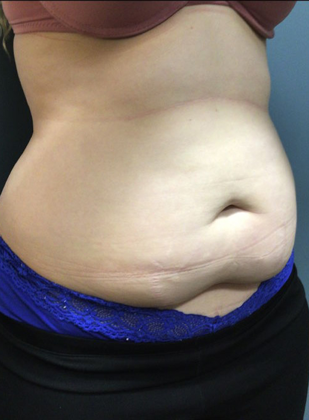 Tummy Tuck Patient Photo - Case 3815 - before view-1