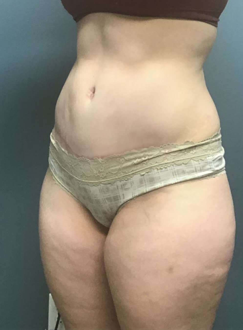 Tummy Tuck Patient Photo - Case 3815 - after view-2
