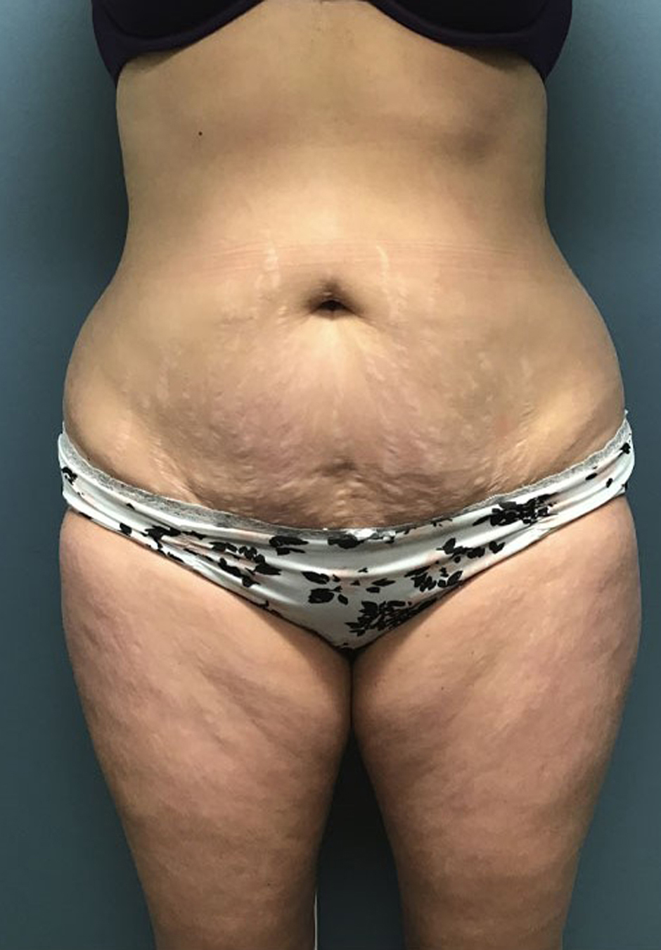 Tummy Tuck Patient Photo - Case 3824 - before view-0