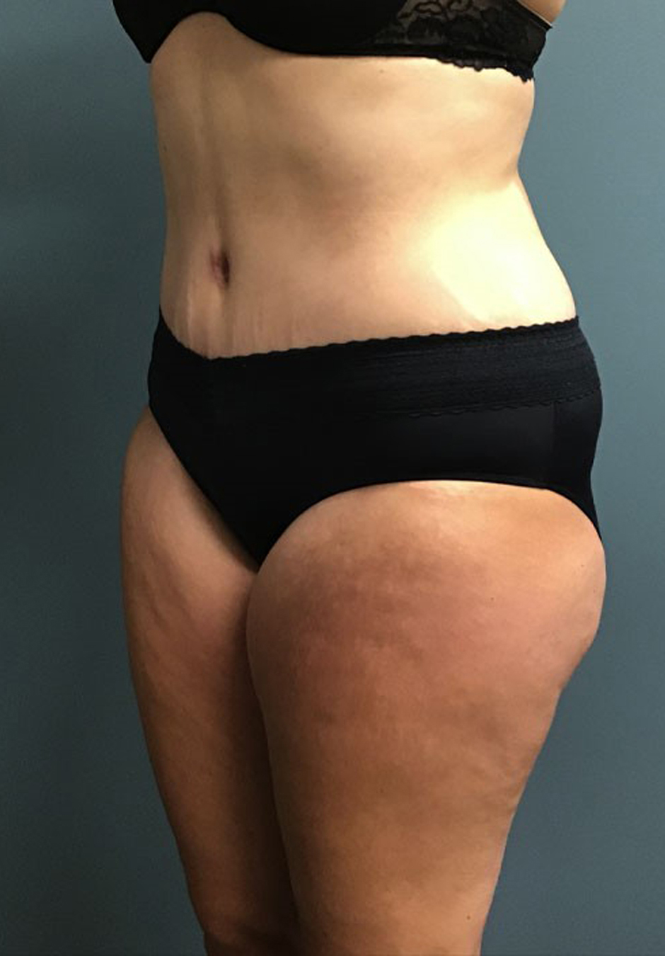 Tummy Tuck Patient Photo - Case 3824 - after view-2