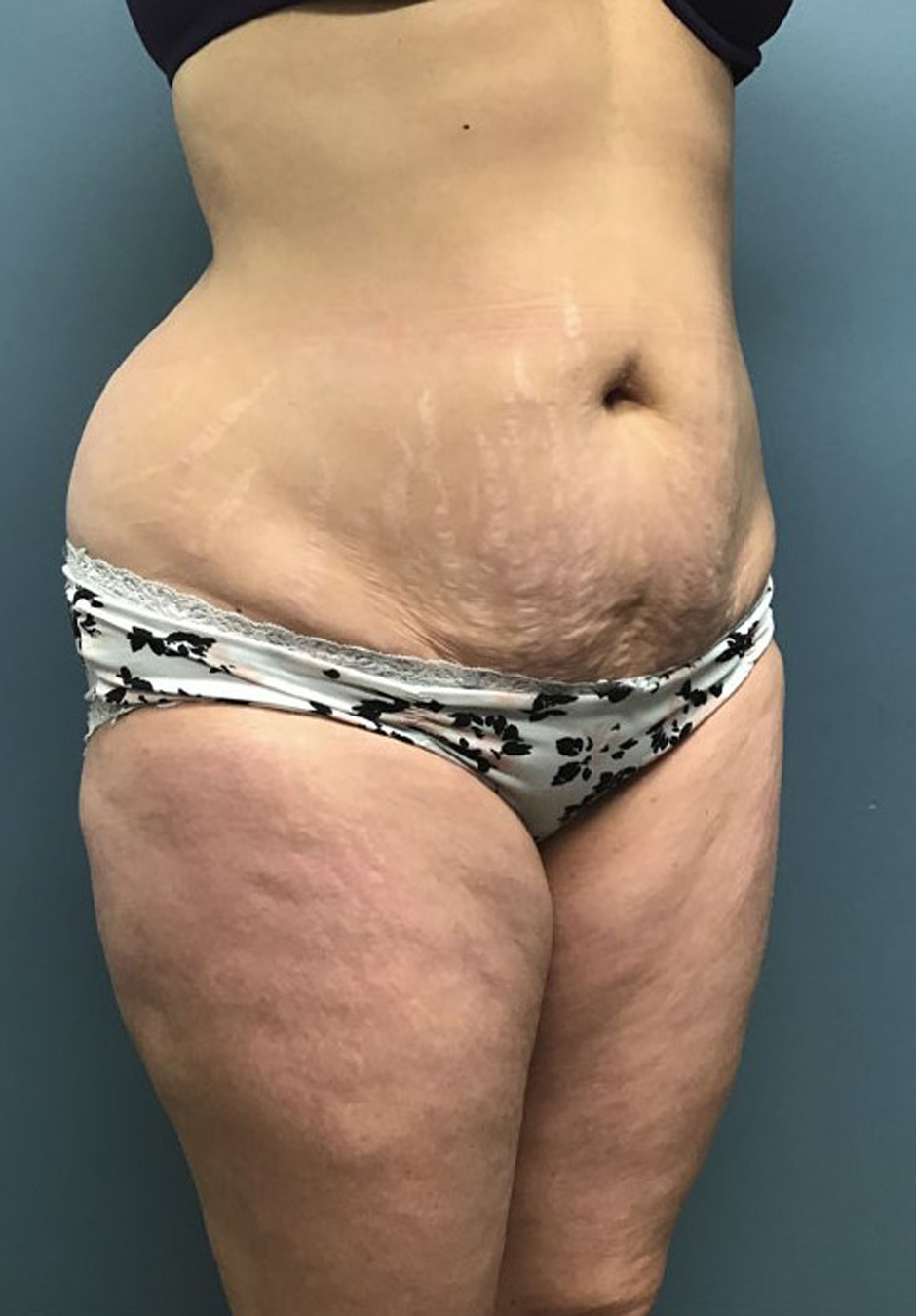 Tummy Tuck Patient Photo - Case 3824 - before view-1