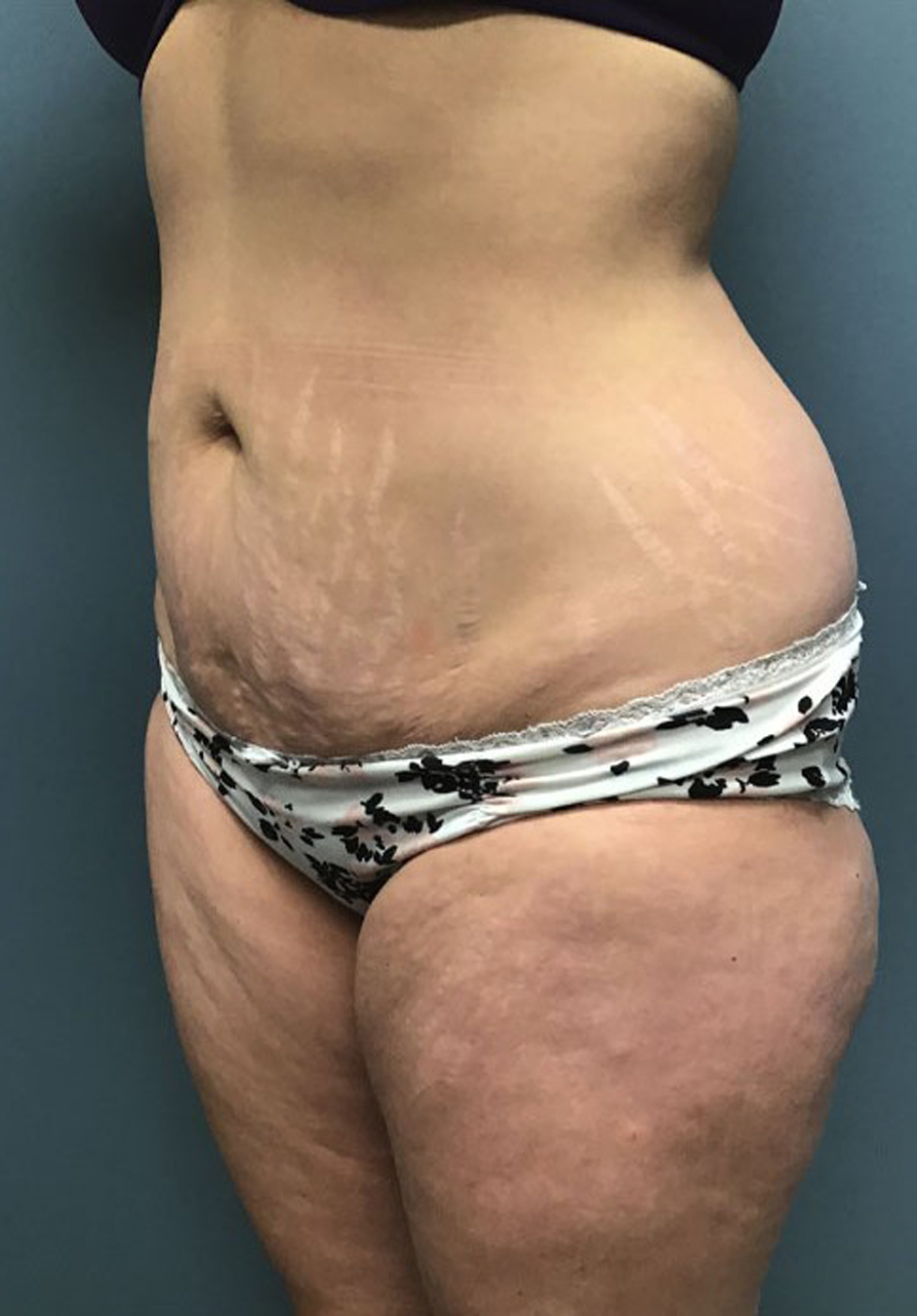 Tummy Tuck Patient Photo - Case 3824 - before view-2