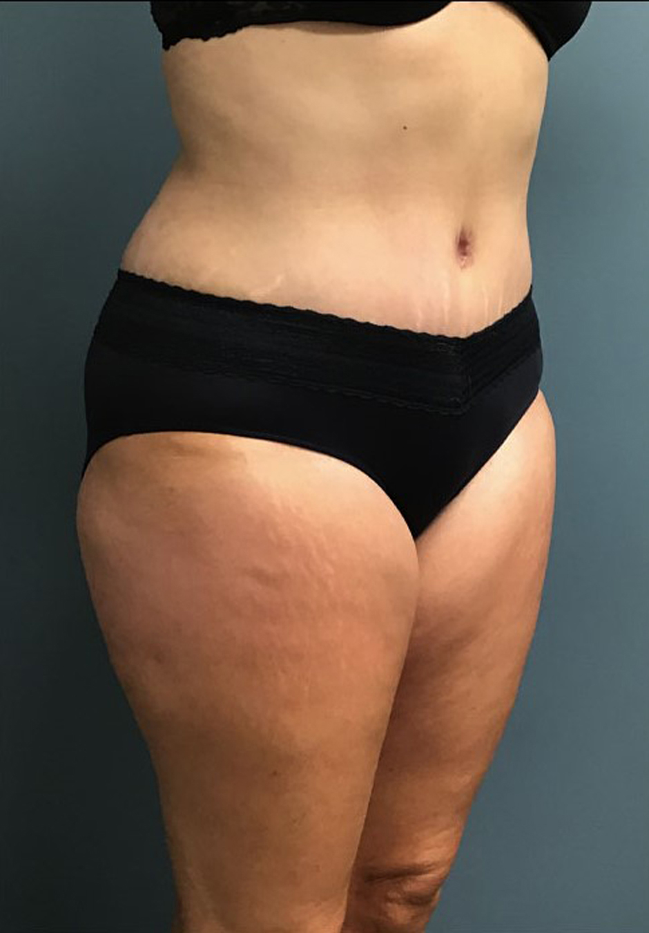 Tummy Tuck Patient Photo - Case 3824 - after view-1