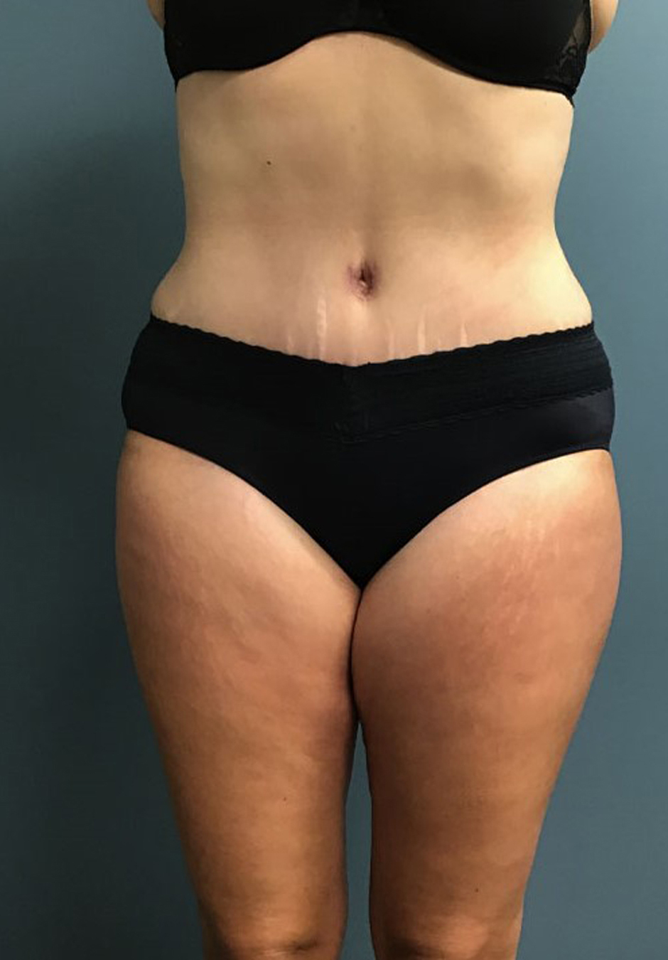 Tummy Tuck Patient Photo - Case 3824 - after view