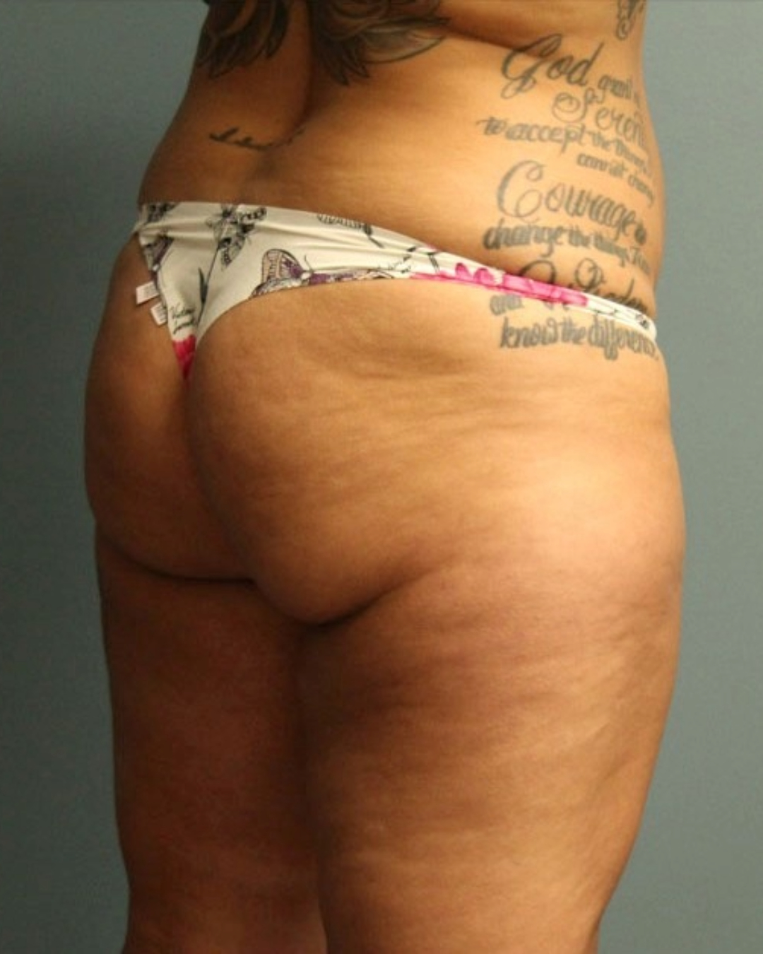 Brazilian Butt Lift Patient Photo - Case 3831 - before view-1