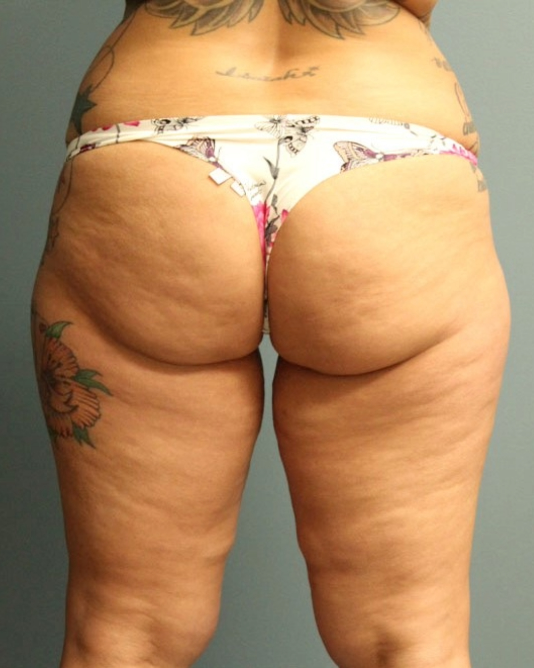 Brazilian Butt Lift Patient Photo - Case 3831 - before view-0