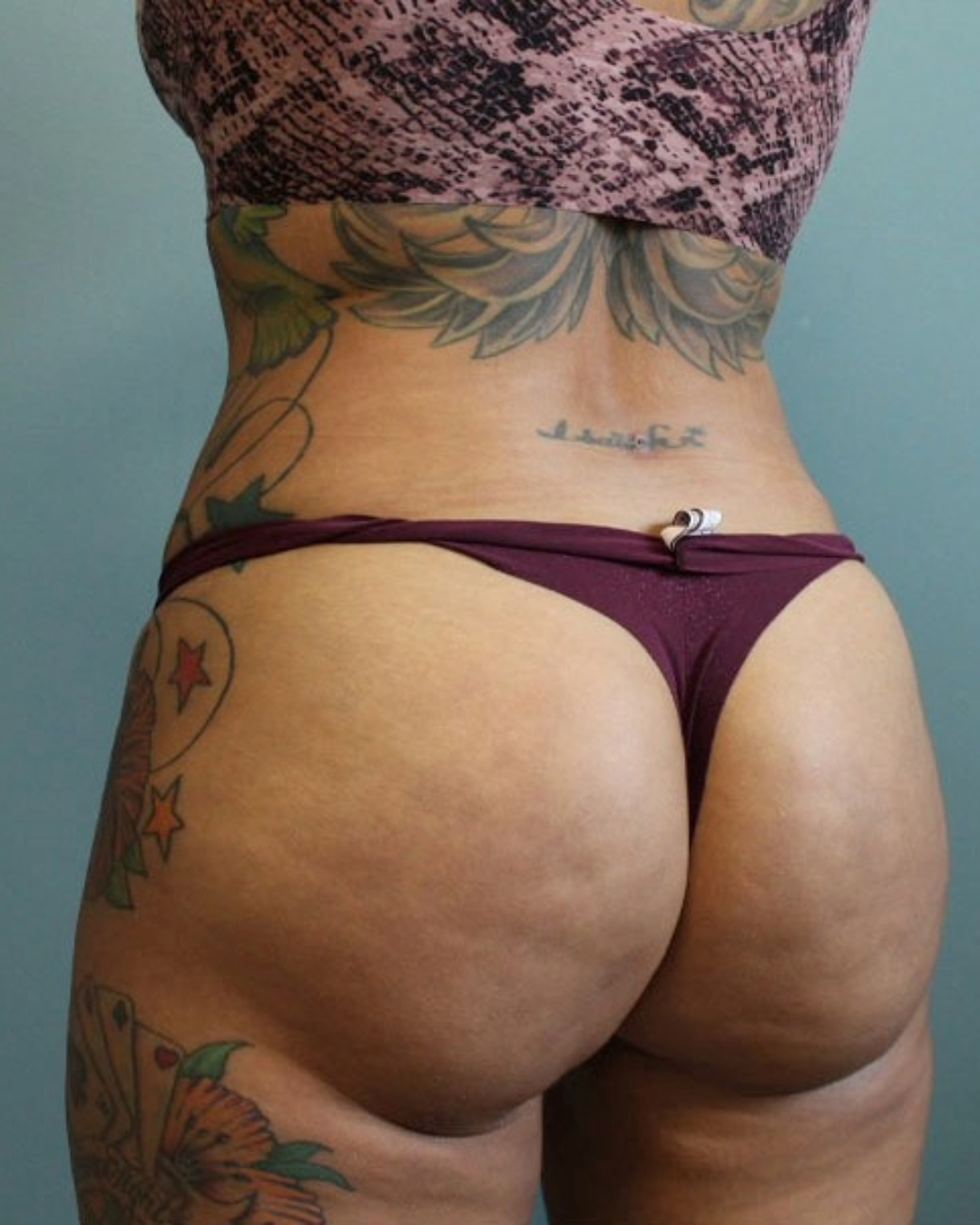 Brazilian Butt Lift Patient Photo - Case 3831 - after view-2