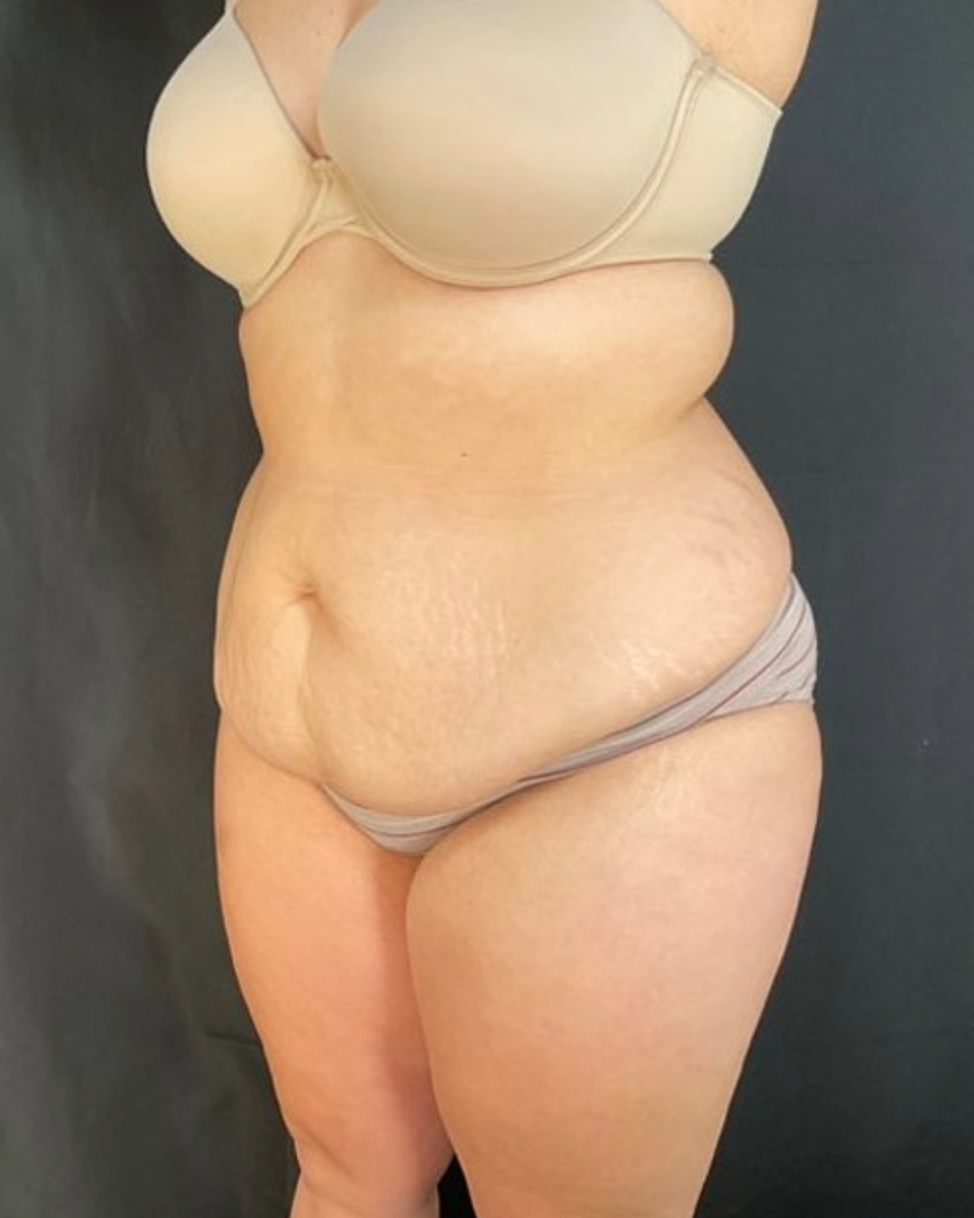 Tummy Tuck Patient Photo - Case 3842 - before view-2