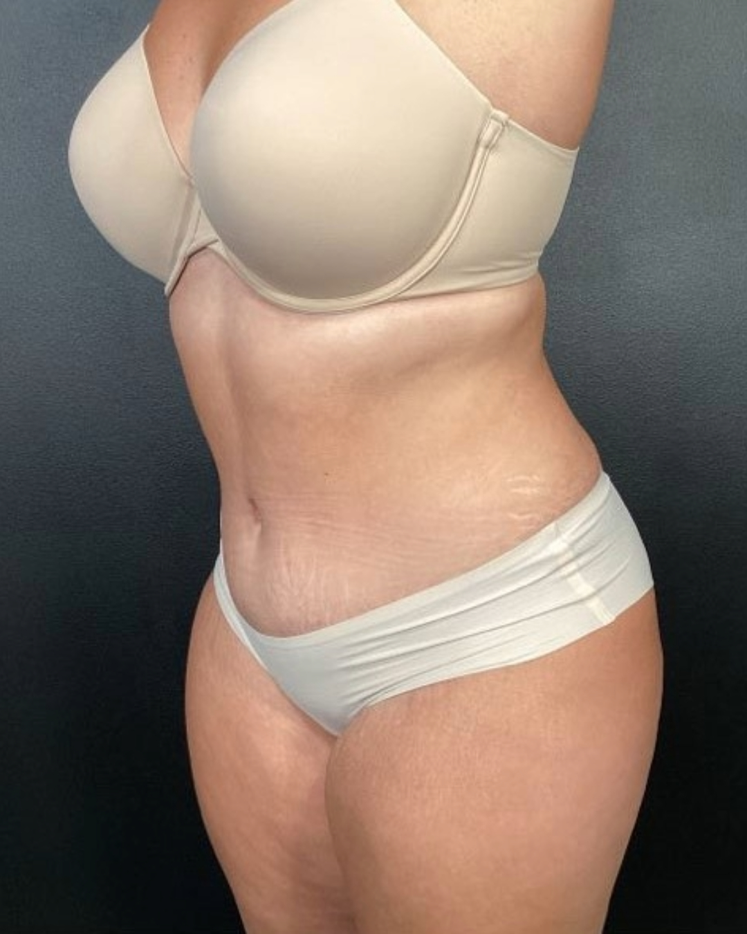 Tummy Tuck Patient Photo - Case 3842 - after view-2