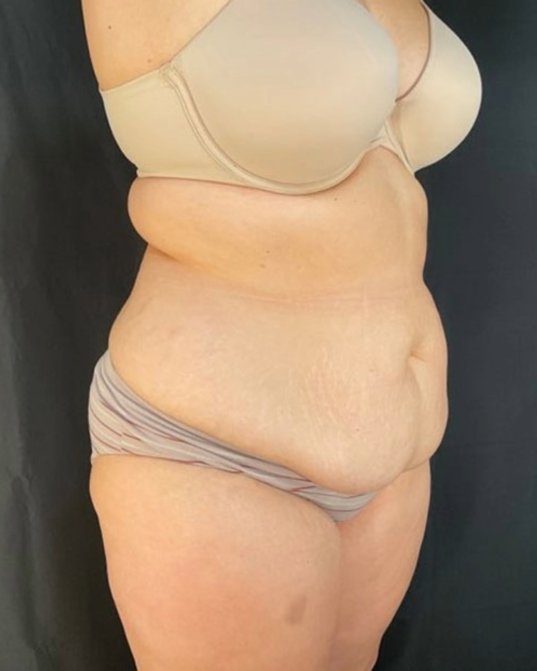 Tummy Tuck Patient Photo - Case 3842 - before view-1