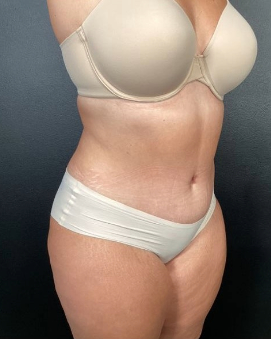Tummy Tuck Patient Photo - Case 3842 - after view-1