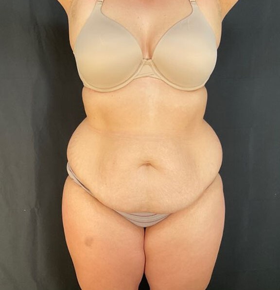 Tummy Tuck Patient Photo - Case 3842 - after view-0