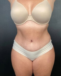 Tummy Tuck - Case 3842 - After