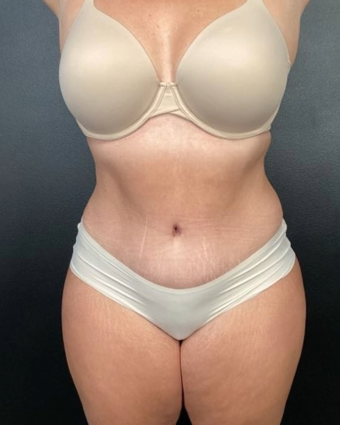 Tummy Tuck Patient Photo - Case 3842 - after view-0