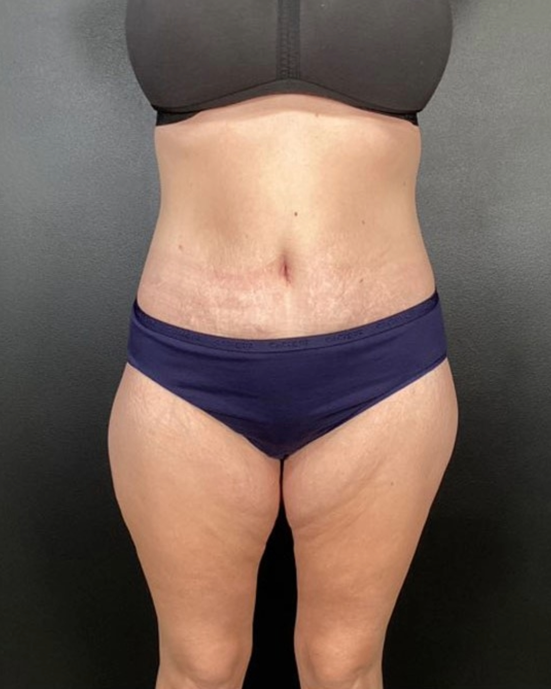 After Weight Loss Patient Photo - Case 3857 - after view
