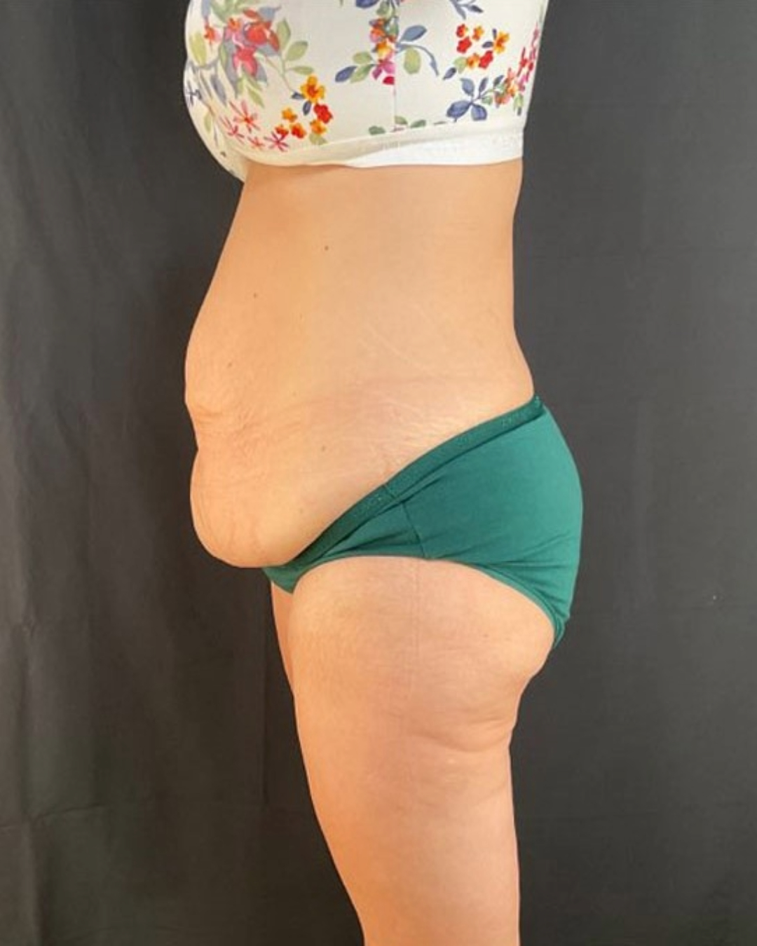 After Weight Loss Patient Photo - Case 3857 - before view-1