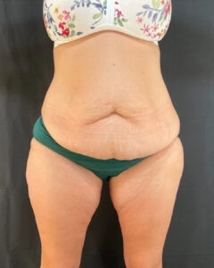 After Weight Loss - Case 3857 - Before