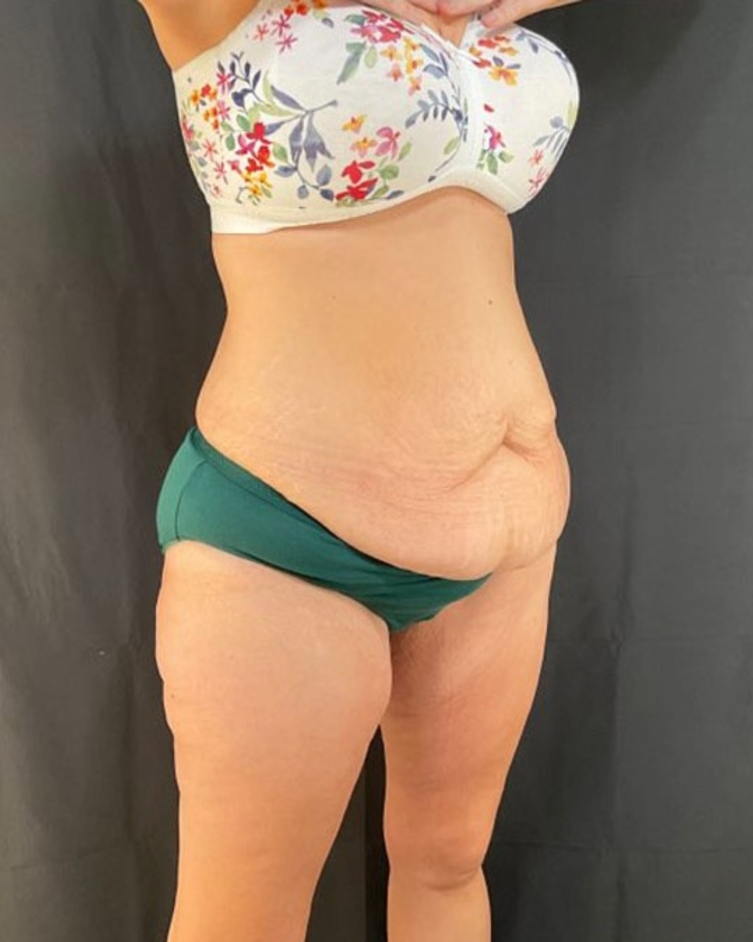 After Weight Loss Patient Photo - Case 3857 - before view-2