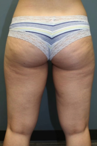 Brazilian Butt Lift - Case 3877 - Before