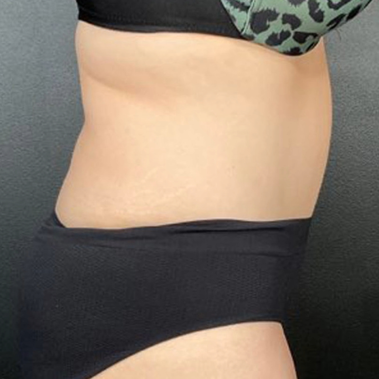 Tummy Tuck Patient Photo - Case 3922 - after view-1