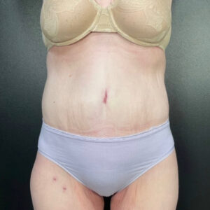 Tummy Tuck - Case 3939 - After