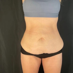 Tummy Tuck - Case 3946 - After