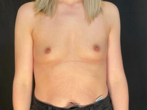 Breast Augmentation - Case 3949 - Before
