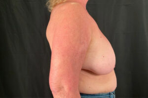 Breast Lift - Case 3952 - Before