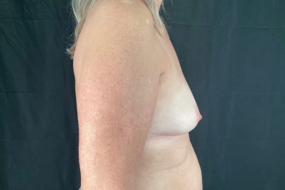 Breast Augmentation Patient Photo - Case 3955 - before view-1