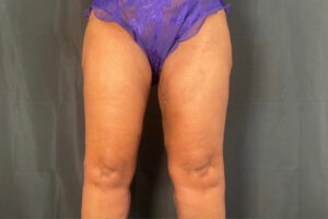 Thigh Lift - Case 3968 - After