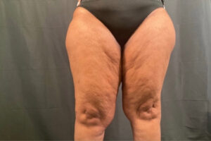 Thigh Lift - Case 3968 - Before