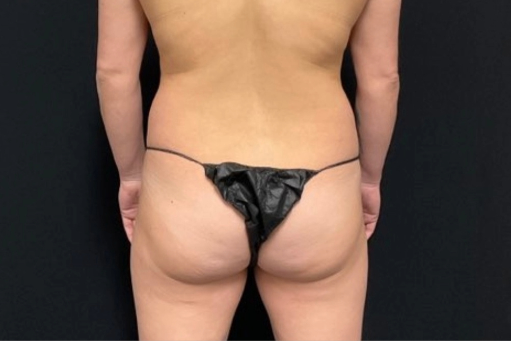 Brazilian Butt Lift Patient Photo - Case 3977 - before view-2