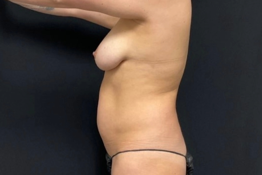 Liposuction Patient Photo - Case 3977 - before view-1