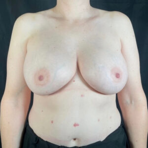 Breast Lift - Case 3988 - Before