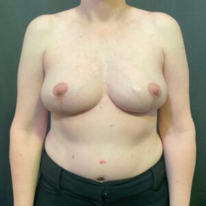 Breast Lift - Case 3988 - After