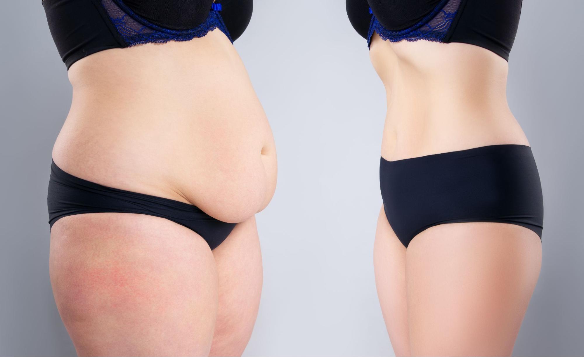 6 Tips for Aftercare Following Your Tummy Tuck