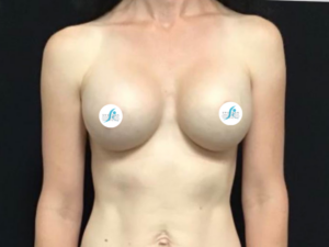 Breast Augmentation - Case 4602 - After