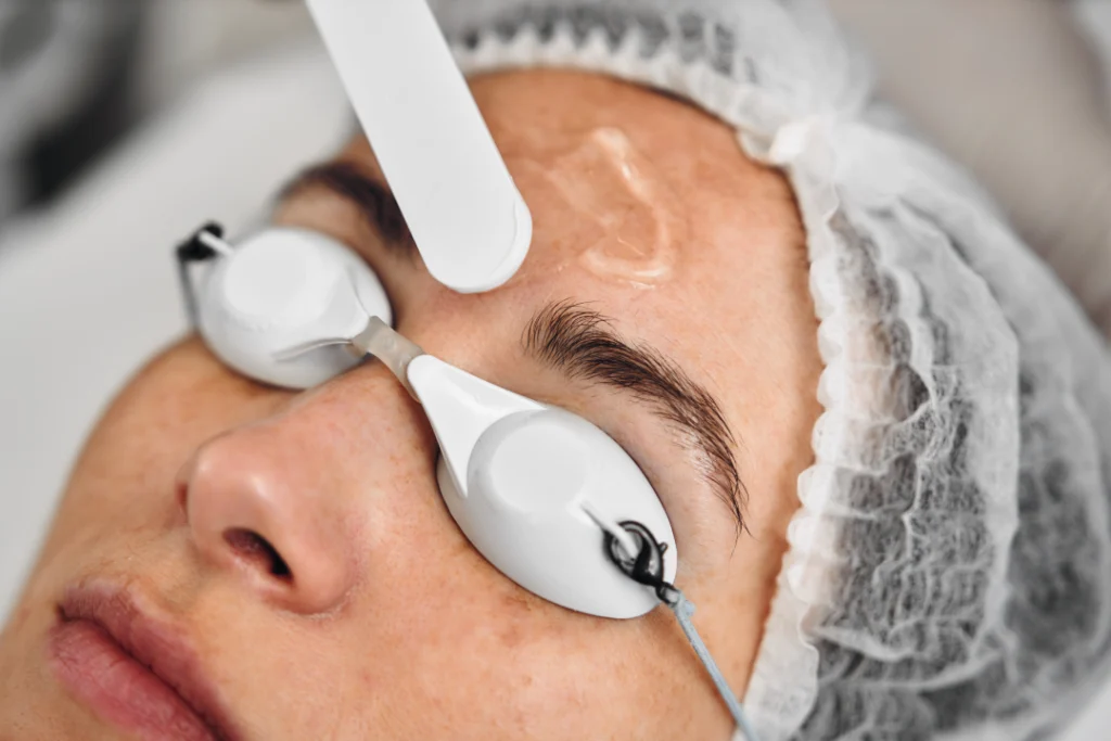 Patient preparation for IPL laser treatment with protective eye shields.