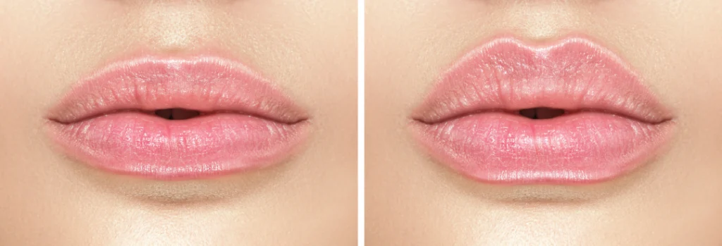 A before-and-after comparison of a lip filler procedure showing fuller and more defined lips.