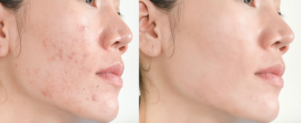 Hydrafacial before and after clear skin