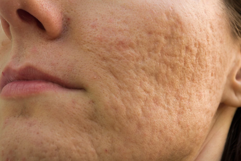 Close-up of cheek showing acne scarring before injectables treatment.