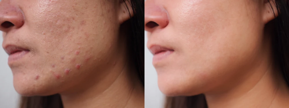 Side-by-side comparison of acne scars before and after injectables.