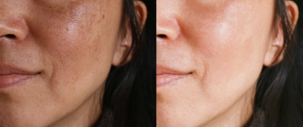 Close-up before and after BBL treatment showing improved skin clarity.