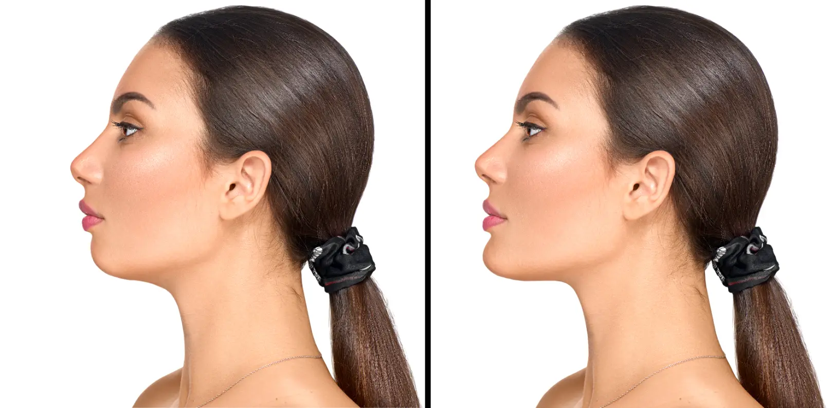 Side-by-side profile views of a woman showing differences in chin projection.