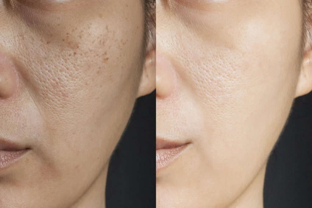 Side-by-side close-up showing differences in cheek skin texture and appearance
